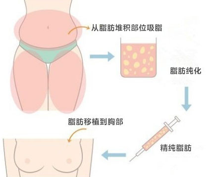 自体脂肪丰乳