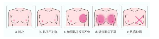 自体脂肪丰乳适宜人群