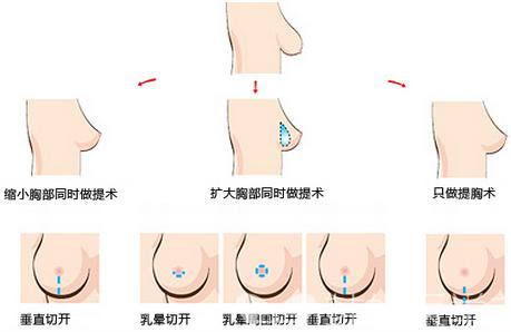 乳房下垂矫正的过程痛苦吗